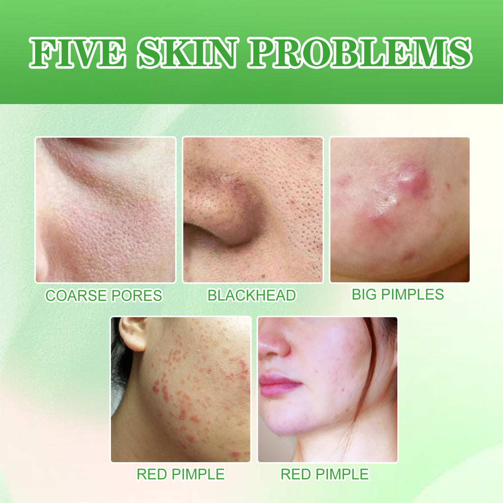 Ácido salicílico para limpeza profunda, controle da oleosidade, remoção de cravos e espinhas, limpeza suave e reparação muscular da acne.